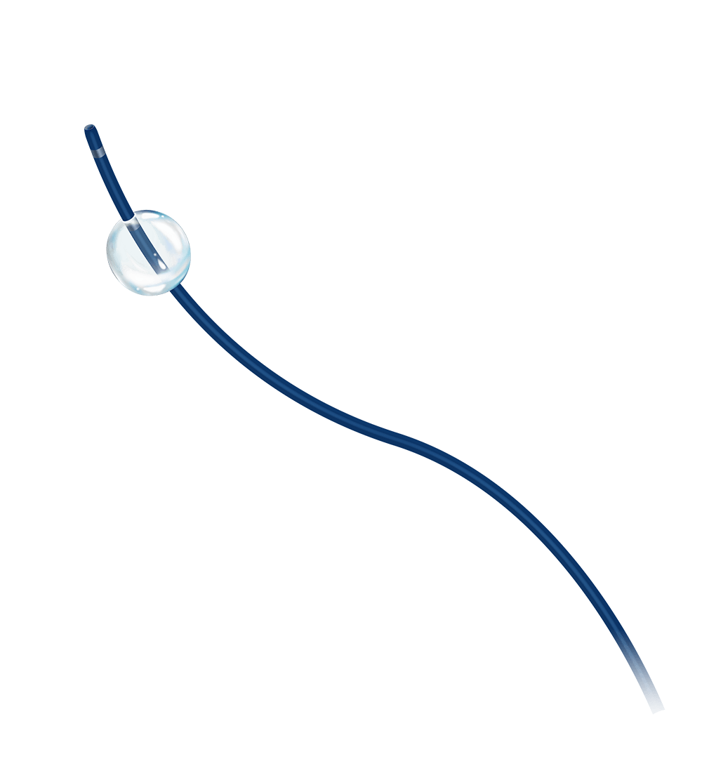 Distail™ Bonbon Balloon Occlusion Microcatheter