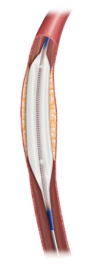 Tresfort™ 18 PTA Balloon Catheter