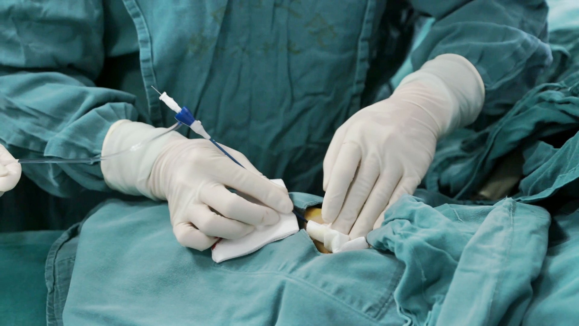Interventional procedure for Liver Cell Cancer via radial artery approach