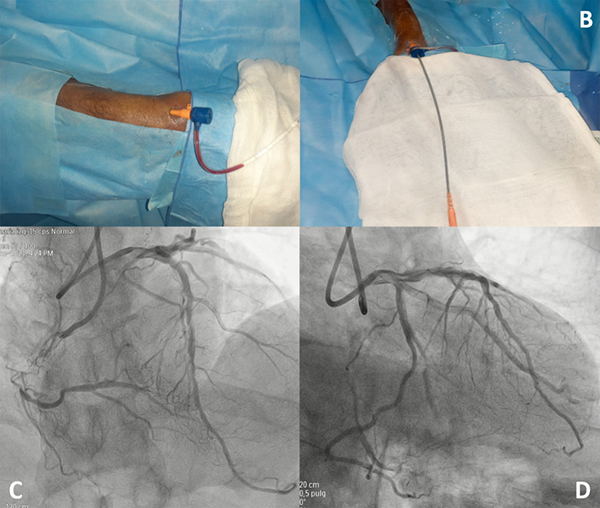 Bilateral Distal Transradial Access for Chronic Total Occlusion Recanalization and Multivessel Coronary Disease Percutaneous Intervention