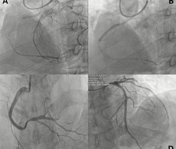 Acceso transradial distal bilateral para recanalización de oclusión total crónica e intervención percutánea para enfermedad coronaria multivaso